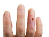 手指腱鞘囊肿怎么办最好 腱鞘囊肿的病因汇总
