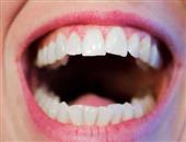 经常口干舌燥口腔溃疡 通过漱口消炎杀菌