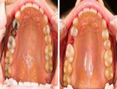 经常发生口角炎怎么办 口角炎的临床表现