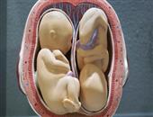 宝宝睾丸鞘膜积液怎么办 什么是睾丸鞘膜积液