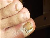 灰指甲最开始会出现哪些症状 应该如何预防灰指甲
