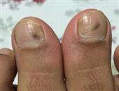 醋精泡脚是否能治疗灰指甲 醋精的制作过程是什么