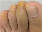 治疗灰指甲用什么药好 能够有效预防灰指甲的措施