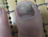 夏季怎样预防灰指甲的发生