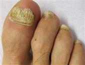 治疗灰指甲的方法包括哪些