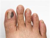 灰指甲的发病诱因有哪些