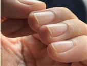 灰指甲的发病原因都有哪些呢