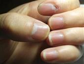 灰指甲的危害以及治疗方法