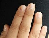 怎样防止灰指甲传染给家人