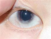 青光眼疾病的相关治疗办法具体是什么呢
