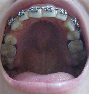 长智齿牙疼的治疗方法 长智齿吃什么好