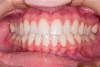 慢性牙周炎是什么 慢性牙周炎不能磨牙吗