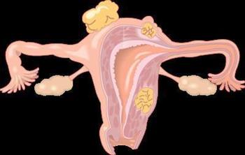 子宫肉瘤治疗办法 子宫肉瘤的症状