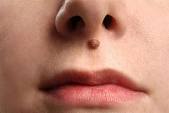 非典型痣是什么意思 它的症状及相关症状有哪些