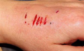 手外伤的症状有哪些 手外伤的判断方法有哪些