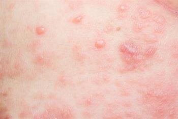梅毒的初期症状有哪些 感染梅毒后的保健措施
