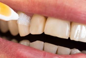 氟斑牙牙齿美白的方法 氟斑牙的预防
