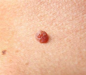 非典型痣是什么意思 它的症状及相关症状有哪些