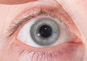 沙眼会遗传吗 沙眼的症状表现是什么