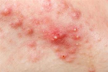 烫伤后结痂后湿疹怎么办 湿疹有哪些症状