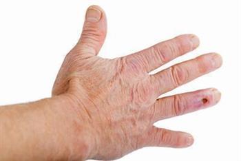 皮肤瘙痒症的原因有哪些 皮肤瘙痒有什么常见症状