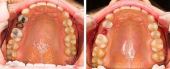 蛀牙与牙菌斑的区别有哪些 引起蛀牙的六大因素
